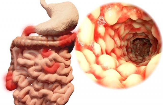 Bu besinler bağırsak kanserinden koruyor 3
