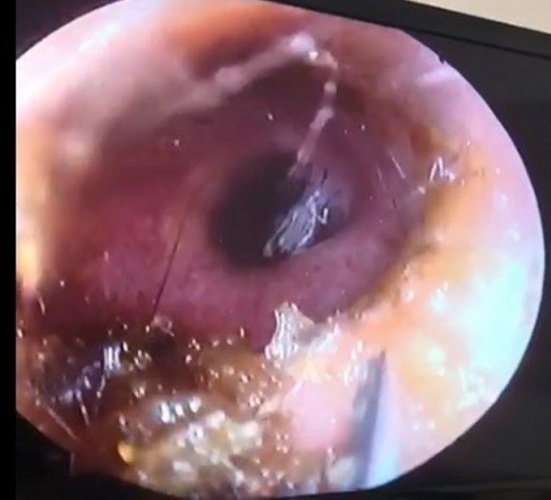 Kulağından canlı olarak çıktı, doktorlar da şaşırdı 5