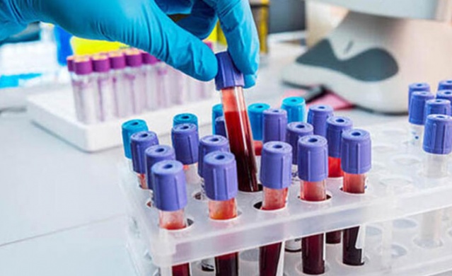 Kansere karşı en dirençli kan grubu açıklandı 3