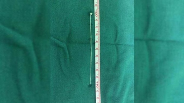 Beyninde 30 yıl onunla yaşadı! Akılalmaz olay... 5