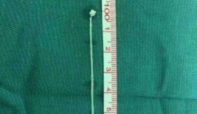 Beyninde 30 yıl onunla yaşadı! Akılalmaz olay... 3