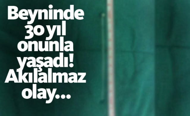 Beyninde 30 yıl onunla yaşadı! Akılalmaz olay... 1