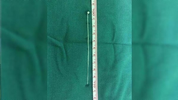 30 yıl boyunca baş ağrısı çekti sebebi şok etti. Foto Galeri 2