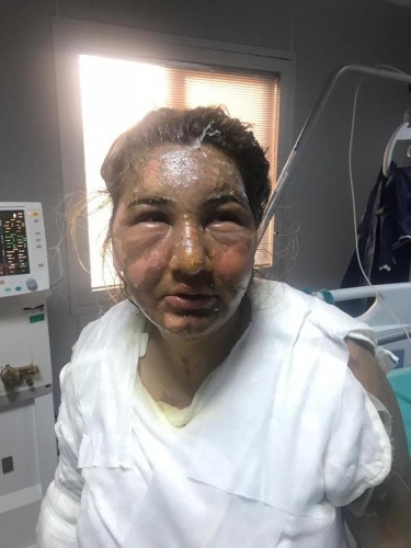 Cezaevinden izinli çıktı, eski eşini yağ ile yaktı 7