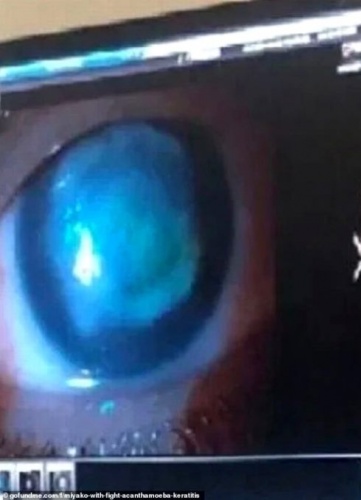 Gözünde lensle denize giren genç kızın hayatı kabusa döndü! 2