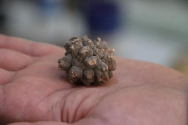 İnanılmaz koleksiyon! Hastalarından çıkardıklarını saklıyor 3