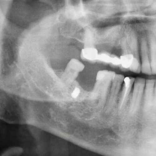 Yanağına saplanan metal parçasıyla 15 yıl yaşadı. Foto Galeri 4