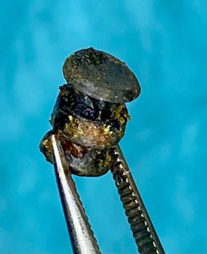 Yanağına saplanan metal parçasıyla 15 yıl yaşadı. Foto Galeri 7