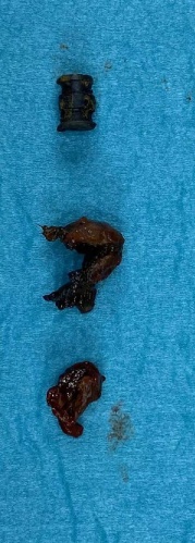 Yanağına saplanan metal parçasıyla 15 yıl yaşadı. Foto Galeri 6