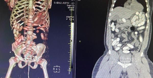 7 yolcunun midesinden 11 kilo kokain çıktı. Foto Haber 5