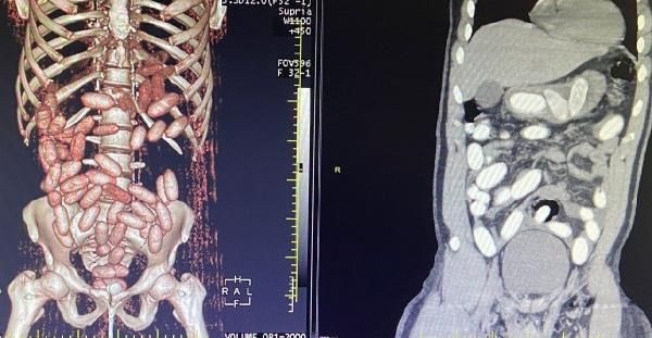 7 yolcunun midesinden 11 kilo kokain çıktı. Foto Haber 9