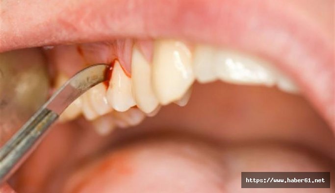 Diş eti problemleri ciddi hastalıkları tetikleyebilir!