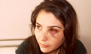 Sol gözünü copladılar !