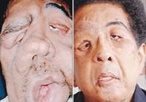 'Fil Adam'a  yüz nakli yapıldı