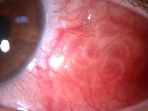 Gözünden 10 santim parazit çıktı