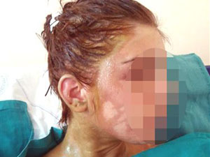 Üniversiteli Genç Kıza Asitli Saldırı