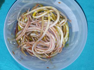 Çocuğun bağırsağından bakın ne çıktı !