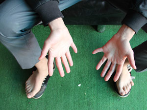 24 parmaklı genci gören hayret ediyor