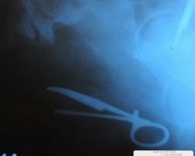 11 yıl karnında makasla yaşadı!