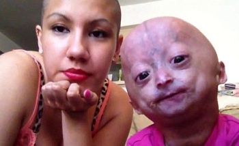 Doktorlar 13 yıl yaşayabileceğini söylüyor