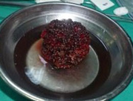 İdrar torbasından çıkan doktoru da şaşırttı