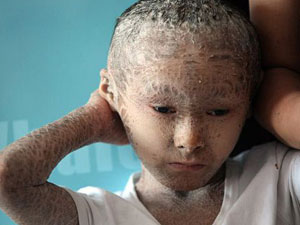 Dünya 'balık çocuğu' konuşuyor