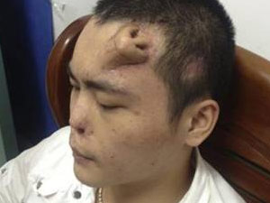 Alnında burunla yaşıyor !