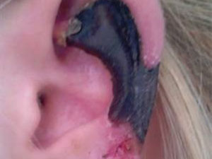 Örümceğin ısırdığı kulağı eridi!