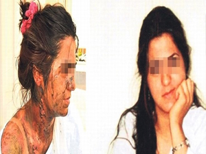 Güzel eşini asit dökerek yaktı!..