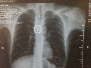 Tıp dünyasını hayrete düşüren olay