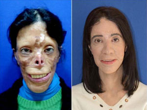 Türk doktorun büyük başarısı: Nakilsiz yüz!