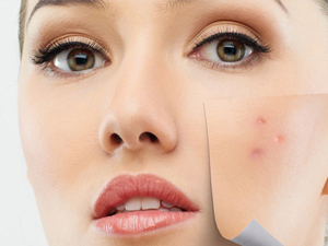 Sivilce Tedavisinde Bilimsel Yöntemler ve Lazer Uygulamaları Hakkında Uyarılar