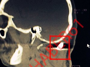 Kafa tasında mermi çıkan adamın son durumu