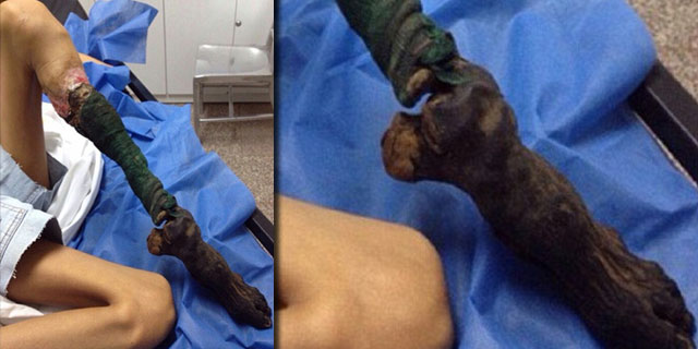 Yılan ısırığı ayağını bu hale getirdi