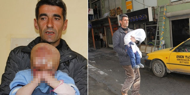 Yüz nakli için yardım bekliyor! Henüz 4 yaşında...