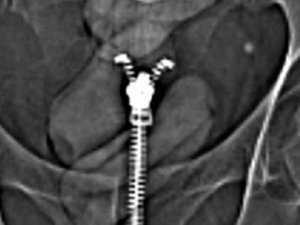 Midesine sakladı ama yine de polisten kaçamadı