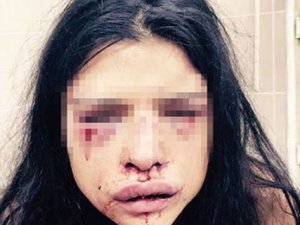 Manken sevgilisini hastanelik etti