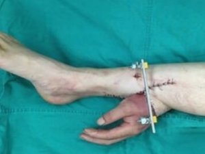 Kopan eli hastanın bacağına dikti!