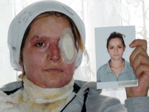 Kocasının kezzapla bu hale getirdiği kadın yardım bekliyor