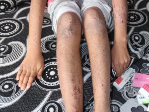 Hastalığı nedeniyle dışlanan Berfin'den yardım çağrısı