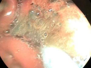 Mahkumun midesinden öyle bir şey çıktı ki!