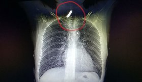 Boğazından çıkan doktorları bile şok etti!