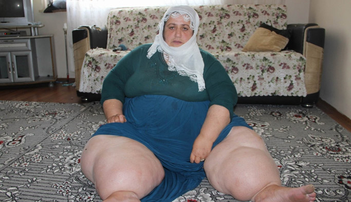 Fil hastalığına yakalandı!