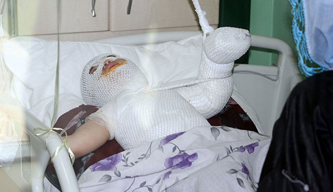 Süt kazanına düşen çocuk feci şekilde yandı