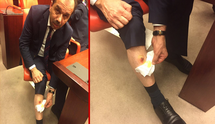 Trabzon Milletvekili Muhammet Balta ısırıldı mı? Adli Tıp açıkladı!