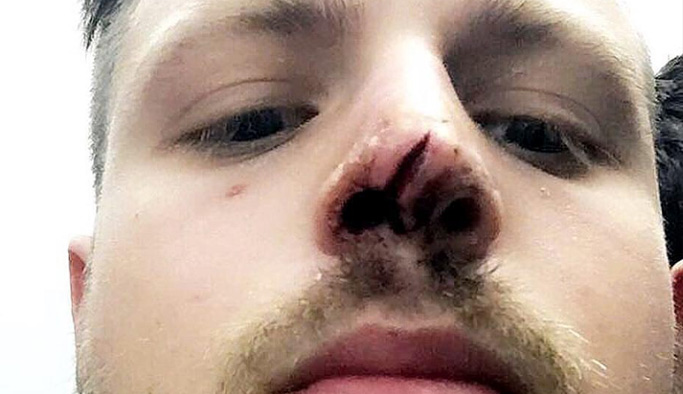 Futbolcunun burnuna dikiş atıldı