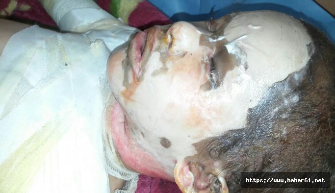 Suriyeli minik Ayşe'nin dramı yürek parçalıyor