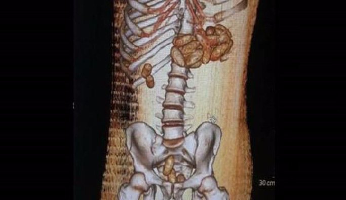 Midesinden 1 kilogram kokain çıktı