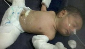 Doktorlar şokta! Bebek 'hamile' doğdu