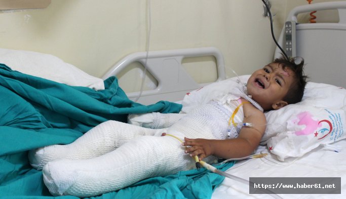 Tandıra düşen 2 yaşındaki çocuğun bacakları kesilebilir